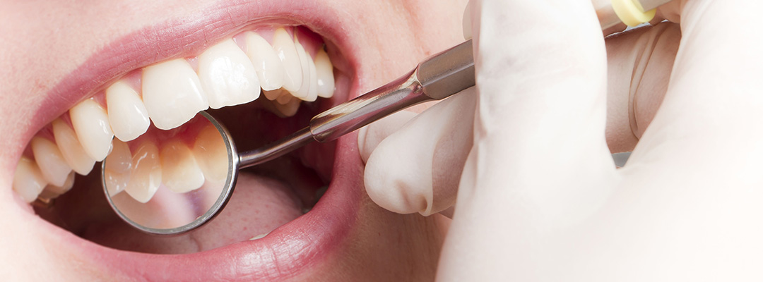 Für gesunde Zähne und kräftiges Zahnfleisch: Prophylaxe Oberkassel